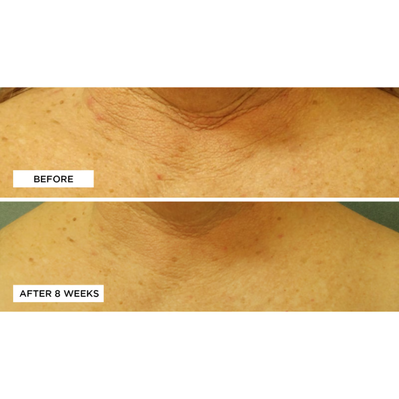 Perricone MD Cold Plasma Plus Neck & Chest SPF25 30ml - Image 4