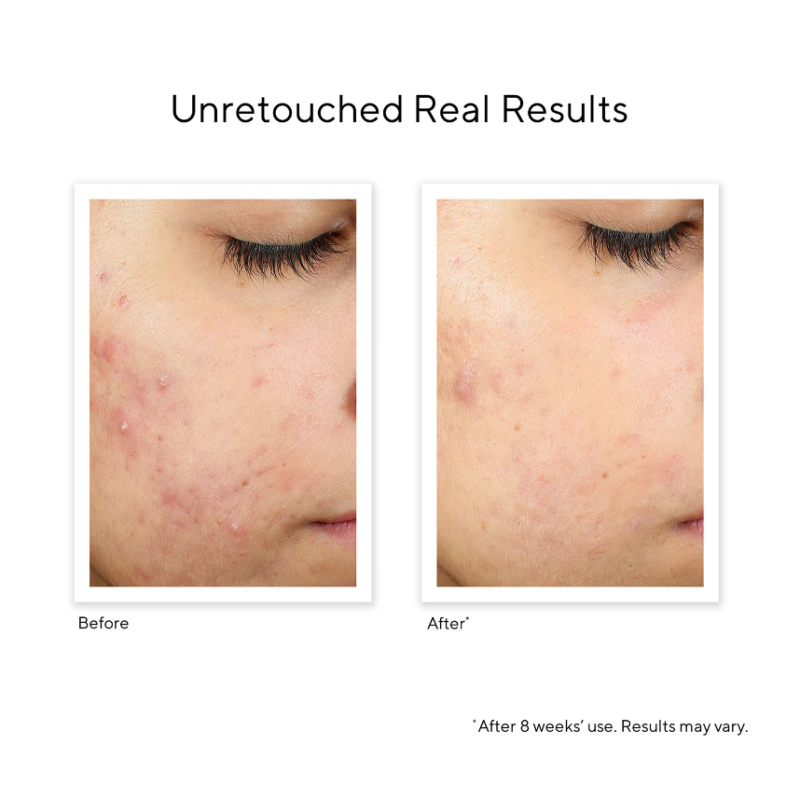 Murad InvisiScar Resurfacing Treatment 15ml - Image 2